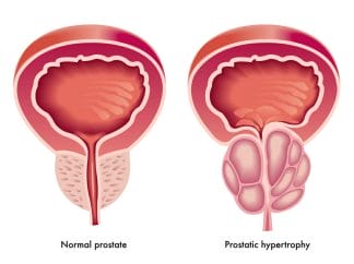  Hipertrofia de la próstata